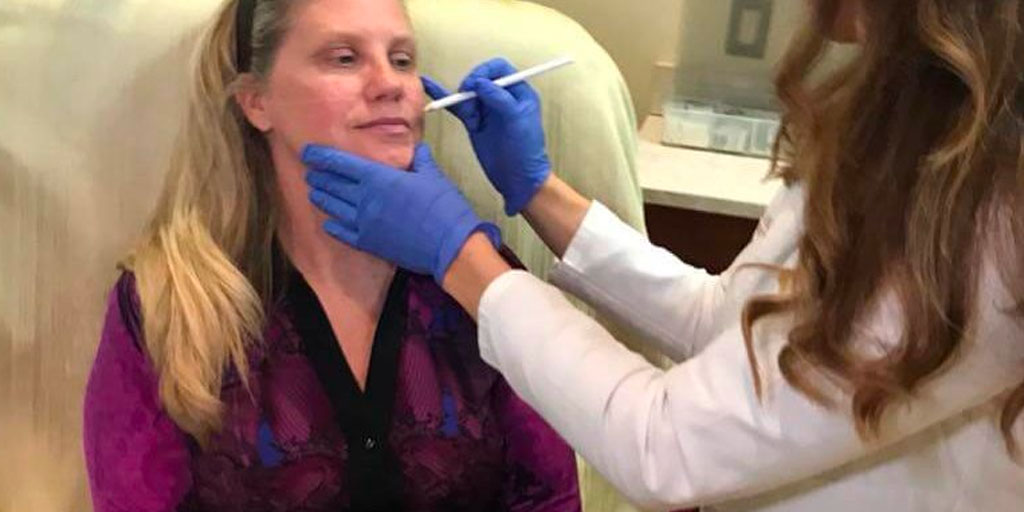 January 10th: Radiesse Dermal Filler to lift and contour cheeks