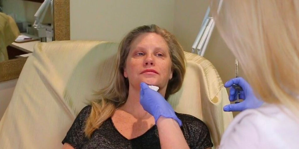 January 23rd: Juvederm in the lips & Second IPL Treatment