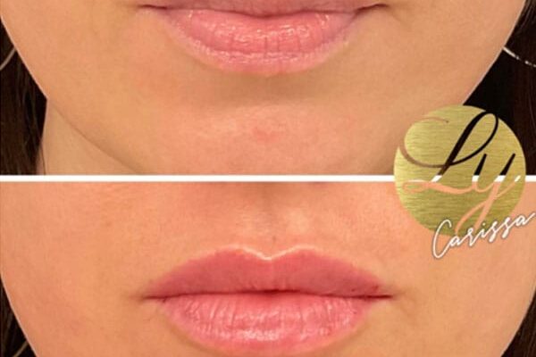 lip-filler-41