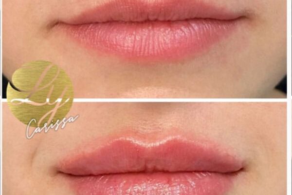 lip-filler-42
