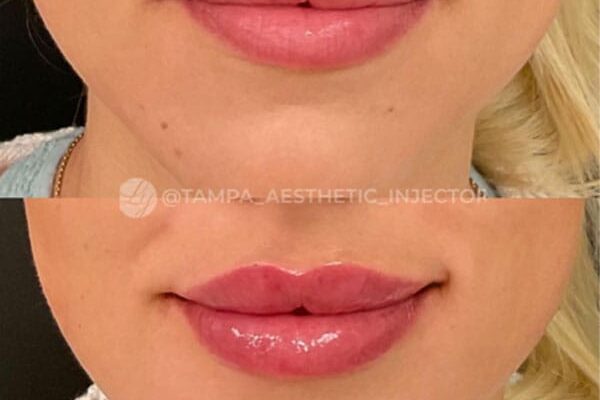 lip-filler-45