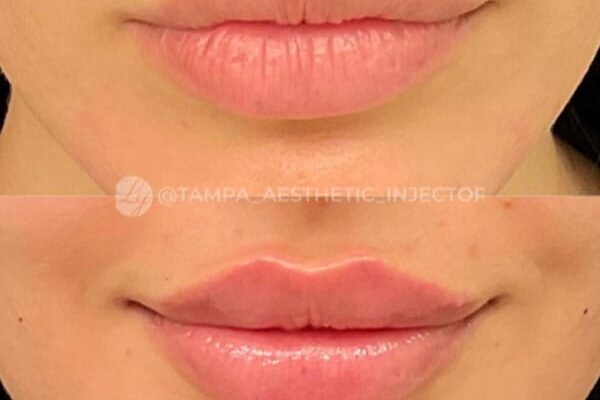 lip-filler-46