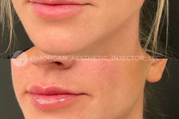 lip-filler-47