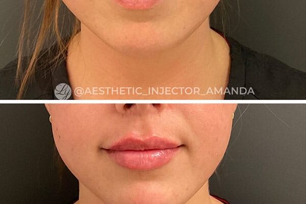 lip-filler-52