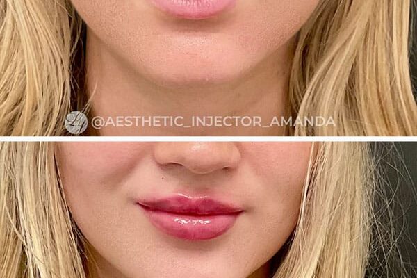 lip-filler-53