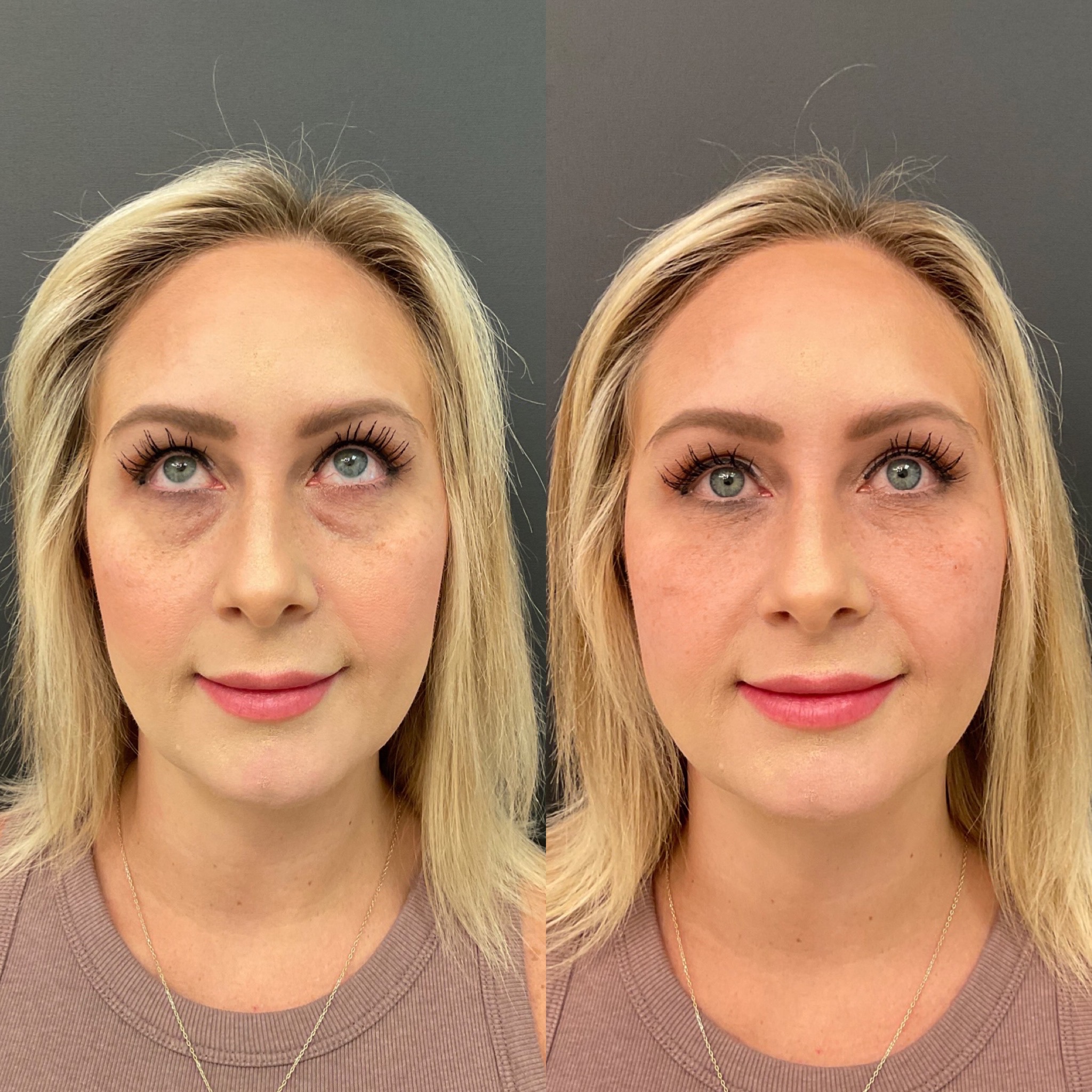 natural look undereye filler
