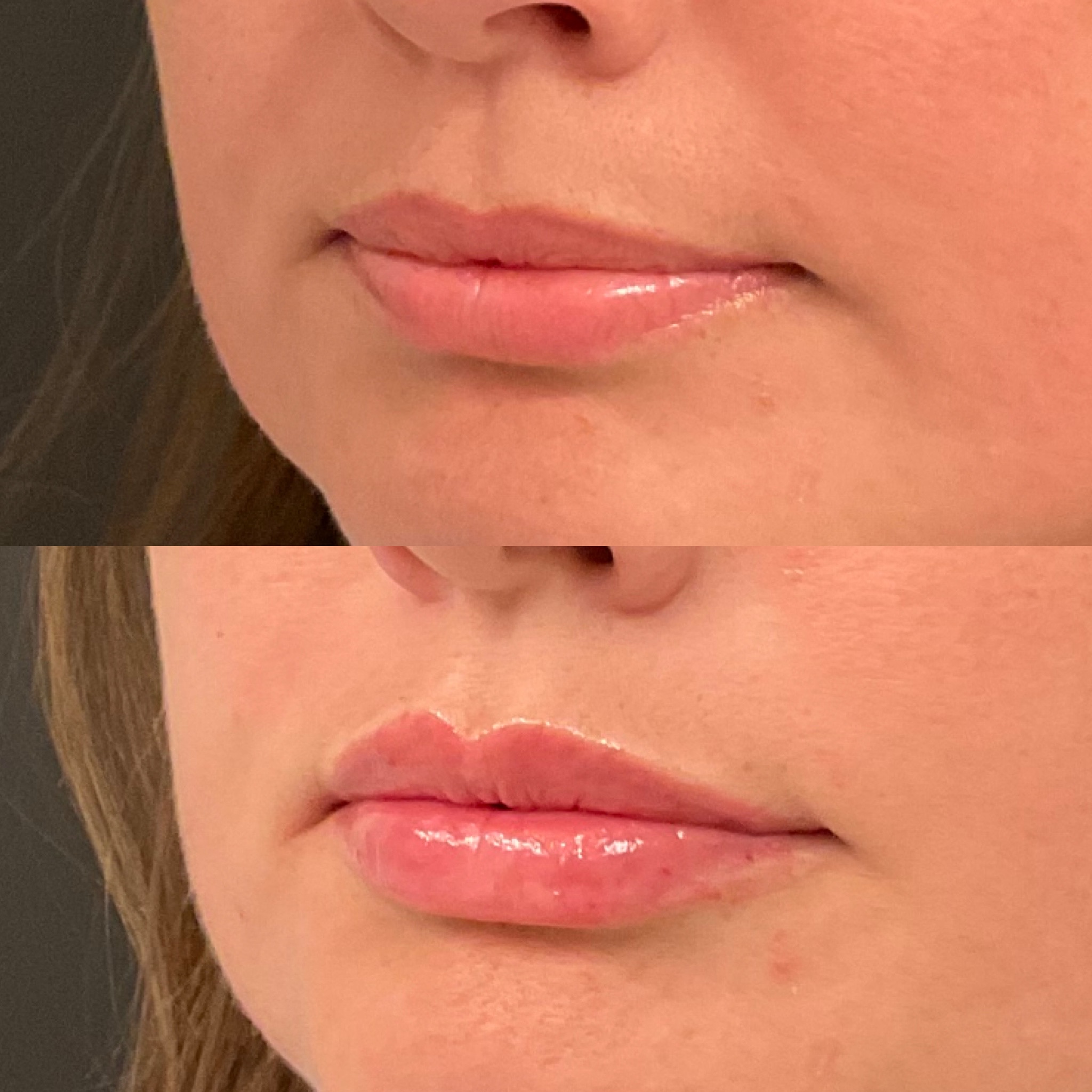 lip augmentation