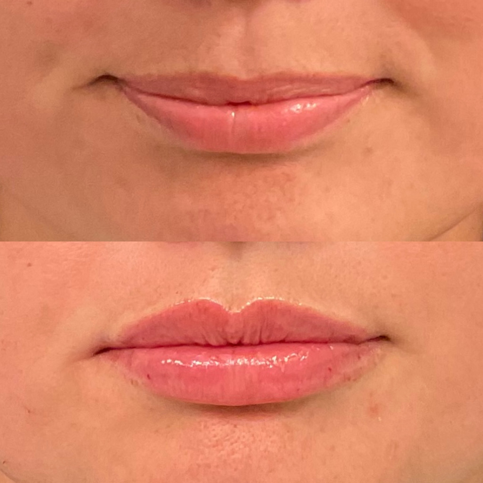 natural looking lip filler