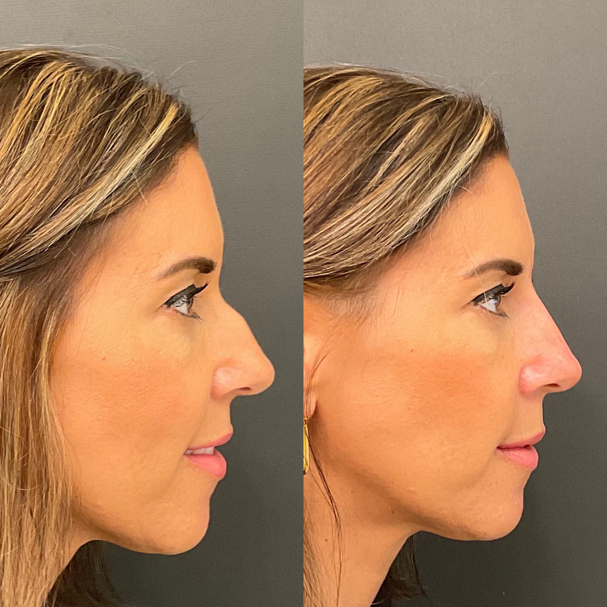 nose filler