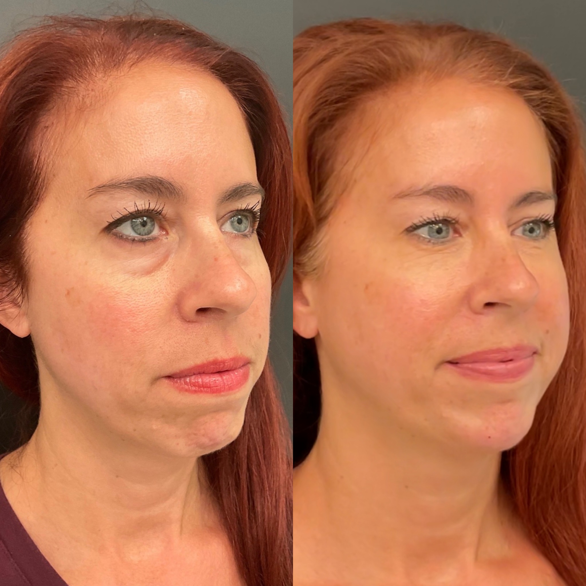 natural look dermal fillers