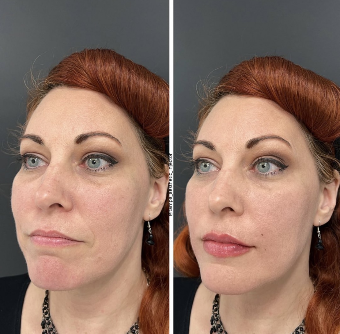undereye filler & lip filler