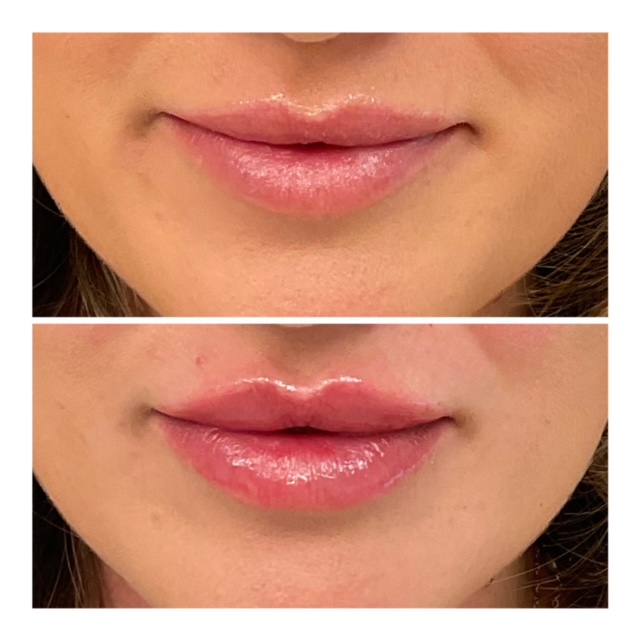 lip filler near me